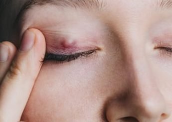 Cirurgia de Cálazio e Exérese de Cistos Palpebrais