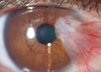 Cirurgia de Pterígio